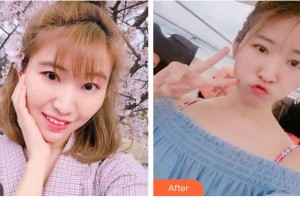 南充潤禾皮膚病?？漆t(yī)院趙成均住院醫(yī)師整形價(jià)格表附切開雙眼皮案例展示