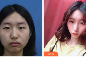 南充潤禾皮膚病專科醫(yī)院萬年整形價(jià)格表附上瞼提肌案例展示