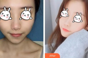 南充潤禾皮膚病?？漆t(yī)院邱坤整形價(jià)格表附光子嫩膚案例展示