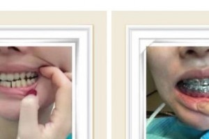 南充美佳口腔診所何成柏整形價格表附金屬托槽矯正案例展示