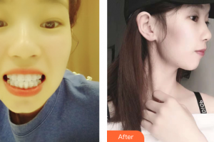 深圳童美口腔門診部唐海英整形價格表附牙齒矯正案例展示