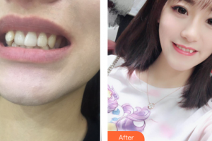 深圳諾德怡景口腔門診部鮑立峰整形價格表附牙齒矯正案例展示