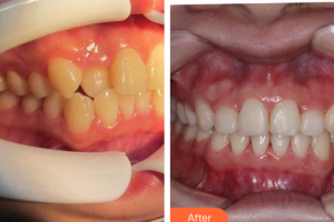 深圳浩海口腔門診部翟虎整形價格表附牙齒隱形矯正案例展示