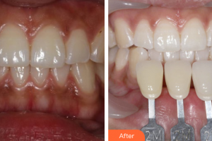 深圳羅湖區(qū)同步口腔門診部黃鐵石整形價格表附冷光美白案例展示