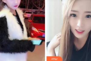 深圳羅湖區(qū)同步口腔門診部王娜整形價格表附牙齒隱形矯正案例展示