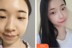 深圳貝加美醫(yī)學美容門診部易江斌整形價格表附假體隆鼻案例展示