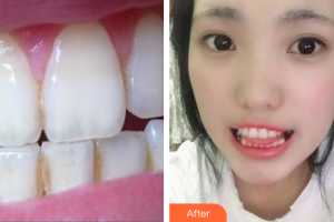 深圳福雅醫(yī)學美容門診部江穎彤整形價格表附超聲波潔牙案例展示