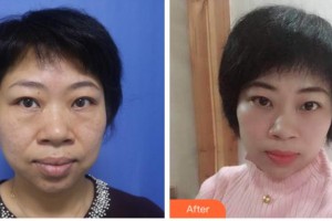 眉山華信醫(yī)學整形美容醫(yī)院溫樹森整形價格表附激光去眼袋案例展示