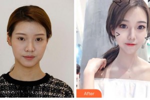 眉山華信醫(yī)學整形美容醫(yī)院李東泰整形價格表附切開雙眼皮案例展示