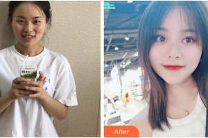 眉山華信醫(yī)學整形美容醫(yī)院金碩正整形價格表附開內眼角案例展示