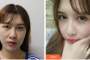 眉山眼耳鼻咽喉?？漆t(yī)院龔恩進整形價格表附切開雙眼皮案例展示