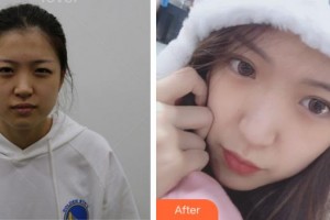 眉山市中醫(yī)院眼科馮馳整形價格表附眼部綜合案例展示