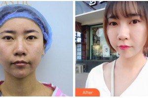 眉山市中醫(yī)院眼科葉小琴整形價格表附祛眼袋案例展示