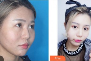 眉山市中醫(yī)院眼科謝啟龍整形價格表附激光去眼袋案例展示