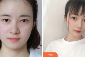 眉山市康復醫(yī)院眼科陳黎霞整形價格表附眼部綜合案例展示