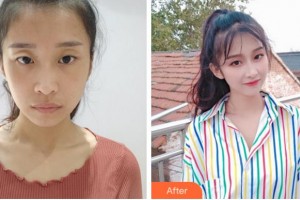 峨眉山市人民醫(yī)院眼科李秀倫整形價格表附切開雙眼皮案例展示