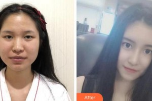 宜賓市第一人民醫(yī)院整形燒傷科陳斌整形價(jià)格表附鼻部綜合案例展示