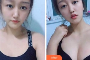 宜賓市第二人民醫(yī)院整形美容科劉建章整形價(jià)格表附自體脂肪隆胸案例展示