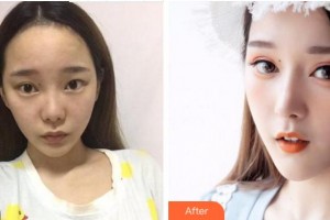 宜賓市第一人民醫(yī)院整形燒傷科鄒同榮整形價(jià)格表附假體隆鼻案例展示