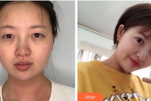 宜賓愛爾優(yōu)視眼科醫(yī)院楊敏整形價(jià)格表附眼部綜合案例展示