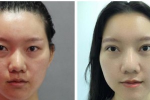 宜賓愛爾優(yōu)視眼科醫(yī)院劉秀麗整形價(jià)格表附眼部綜合案例展示