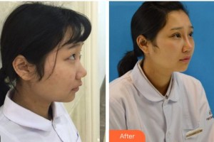 宜賓愛爾優(yōu)視眼科醫(yī)院孫安勝整形價(jià)格表附切開雙眼皮案例展示