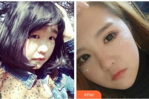 宜賓愛爾優(yōu)視眼科醫(yī)院潘麗梅整形價(jià)格表附埋線雙眼皮案例展示