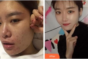 宜賓華膚皮膚病醫(yī)院童顯梅整形價(jià)格表附皮膚管理案例展示