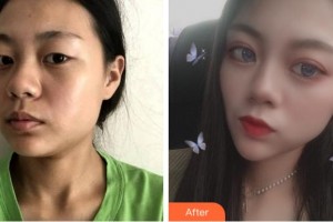 宜賓天使之翼醫(yī)療美容整形門診部周洪超整形價格表附眼部綜合案例展示