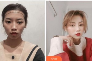 宜賓天使之翼醫(yī)療美容整形門診部王光斌整形價格表附種植發(fā)際線案例展示