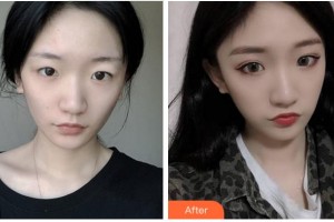 廣安華美悅美整形美容醫(yī)院蔣朝華整形價格表附切開雙眼皮案例展示