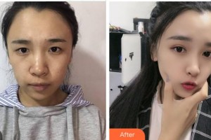 達(dá)州仁美醫(yī)學(xué)整形美容門診部周院長整形價格表附眼部綜合案例展示