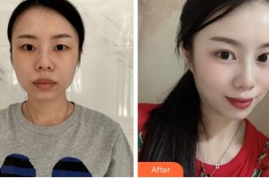 達(dá)州愛爾博視醫(yī)院吳松整形價格表附眼部綜合案例展示