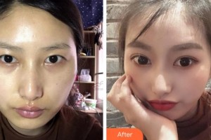 達州市中西醫(yī)結(jié)合醫(yī)院眼科王斌整形價格表附切開雙眼皮案例展示