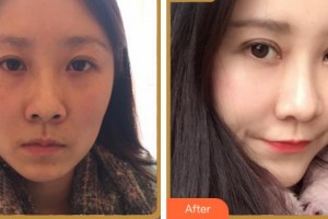 雅安市人民醫(yī)院燒傷整形科付子俊整形價格表附眼部綜合案例展示