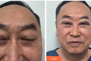 雅安鑫西華口腔整形醫(yī)院李佩紜整形價格表附切開雙眼皮案例展示