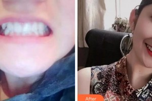 雅安鑫西華口腔整形醫(yī)院李毅整形價格表附牙齒陶瓷矯正案例展示