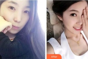 雅安鑫西華口腔整形醫(yī)院周穎整形價格表附牙齒隱形矯正案例展示