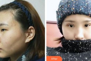 巴中麗人醫(yī)院醫(yī)療美容科孫衛(wèi)星整形價格表附切開雙眼皮案例展示