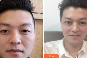 巴中時光醫(yī)學美容門診部李洪強整形價格表附切開雙眼皮案例展示