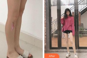 資陽市第一人民醫(yī)院燒傷整形科伍建華整形價格表附激光祛疤案例展示