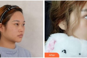 資陽麗人醫(yī)療美容門診部肖麗整形價格表附鼻部綜合案例展示