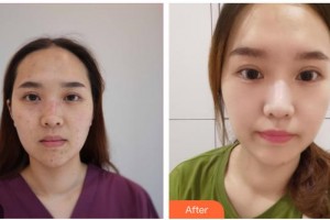 資陽麗人醫(yī)療美容門診部柯春整形價格表附激光點痣案例展示