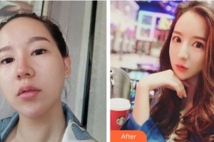 資陽伊之美整形美容醫(yī)院張梅整形價格表附鼻部綜合案例展示