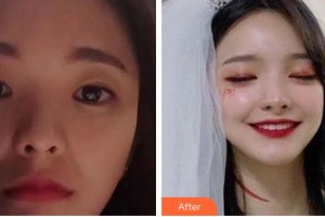 資陽伊之美整形美容醫(yī)院鄒家旋整形價格表附美白導入案例展示