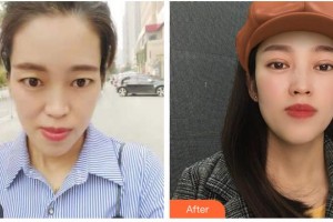 資陽維多利亞醫(yī)療美容醫(yī)院黃國強整形價格表附切開雙眼皮案例展示