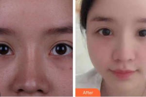 資陽市中醫(yī)醫(yī)院眼科王耀住院醫(yī)師整形價格表附眼部修復案例展示