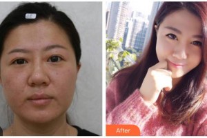 資陽市中醫(yī)醫(yī)院眼科張永整形價格表附埋線雙眼皮案例展示