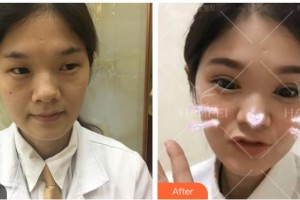 資陽市中醫(yī)醫(yī)院眼科秦慶整形價格表附切開雙眼皮案例展示