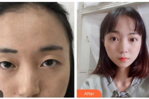 資陽市中醫(yī)醫(yī)院眼科宋良智整形價格表附切開雙眼皮案例展示